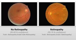 Diabetic Retinopathy Detection